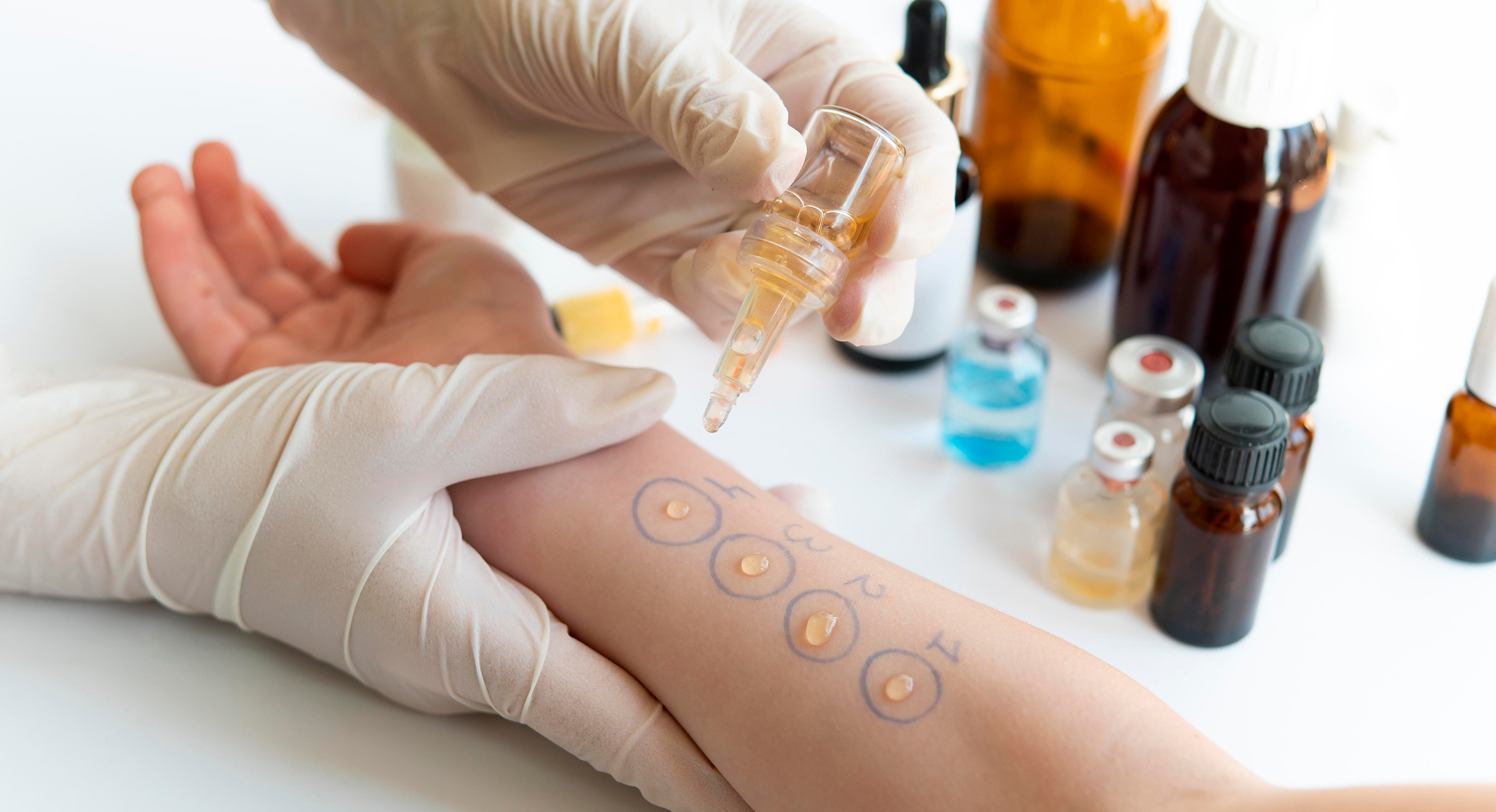 Allergy Testing